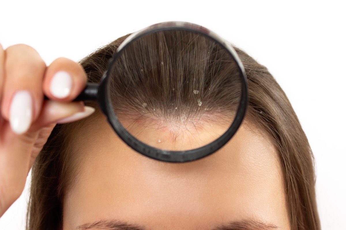 Łojotokowe zapalenie skóry głowy — diagnostyka i leczenie